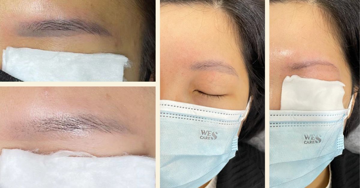 Top Places for Eyebrow Embroidery Removal in Singapore